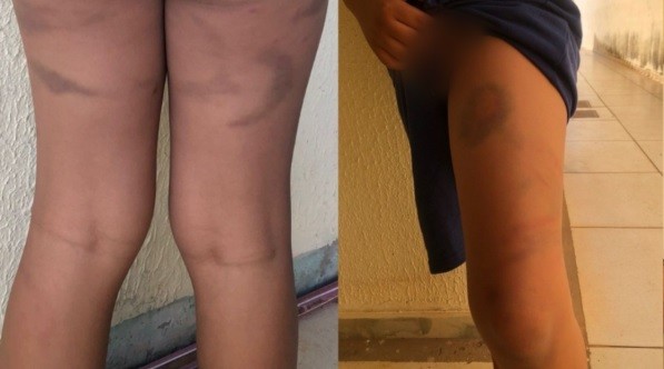 Pai é denunciado após bater e entregar filho de 7 anos com hematomas à mãe